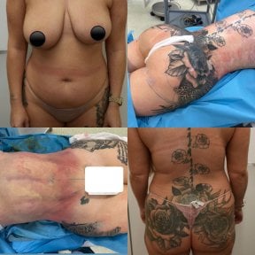 before-after photo brazilskaa-podtazka-agodic