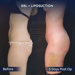 before-after photo brazilskaa-podtazka-agodic