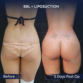 before-after photo brazilskaa-podtazka-agodic