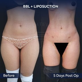 before-after photo brazilskaa-podtazka-agodic