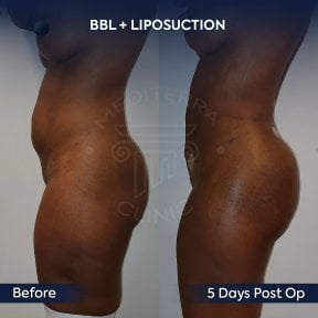 before-after photo brazilskaa-podtazka-agodic
