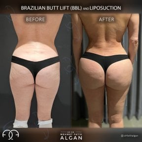 before-after photo brazilskaa-podtazka-agodic