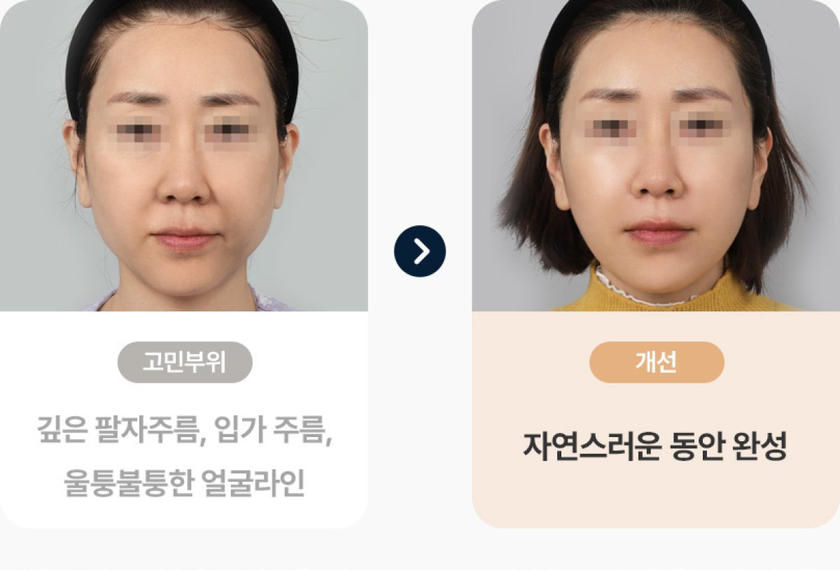 Resultados antes y después de terapia PRP: menos arrugas y piel facial más suave