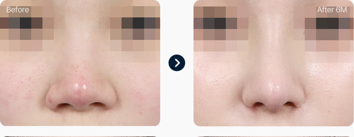 Resultados antes y después de rinoplastia de punta nasal, mejora tras 6 meses