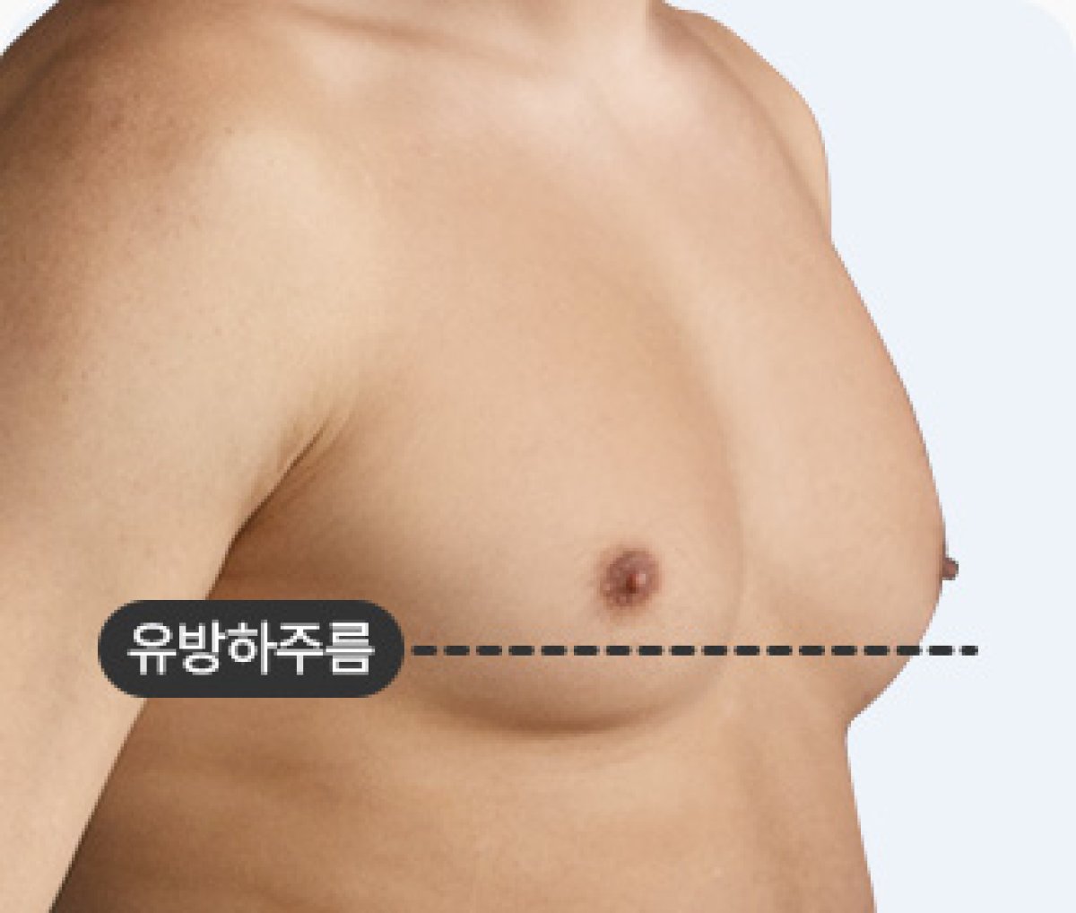 Resultado antes de liposucción Vaser para ginecomastia – pecho masculino agrandado