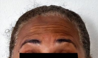 Forehead wrinkles before nonsurgical facelift at Punta cana dentist odontologia familiar