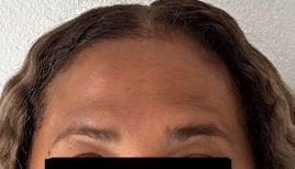 Nonsurgical facelift result at Punta cana dentist odontologia familiar, smoother forehead skin