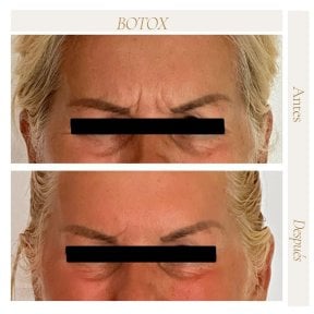 Before and after Botox results at Punta cana dentist odontologia familiar, reduced forehead wrinkles