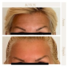 Before and after Botox results at Punta cana dentist odontologia familiar, smoother forehead lines