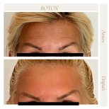 Before and after Botox results at Punta cana dentist odontologia familiar, smoother forehead lines