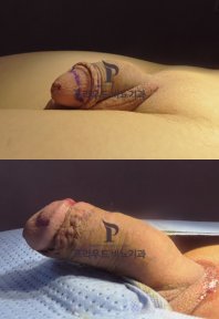 before-after photo uvelicenie-polovogo-clena
