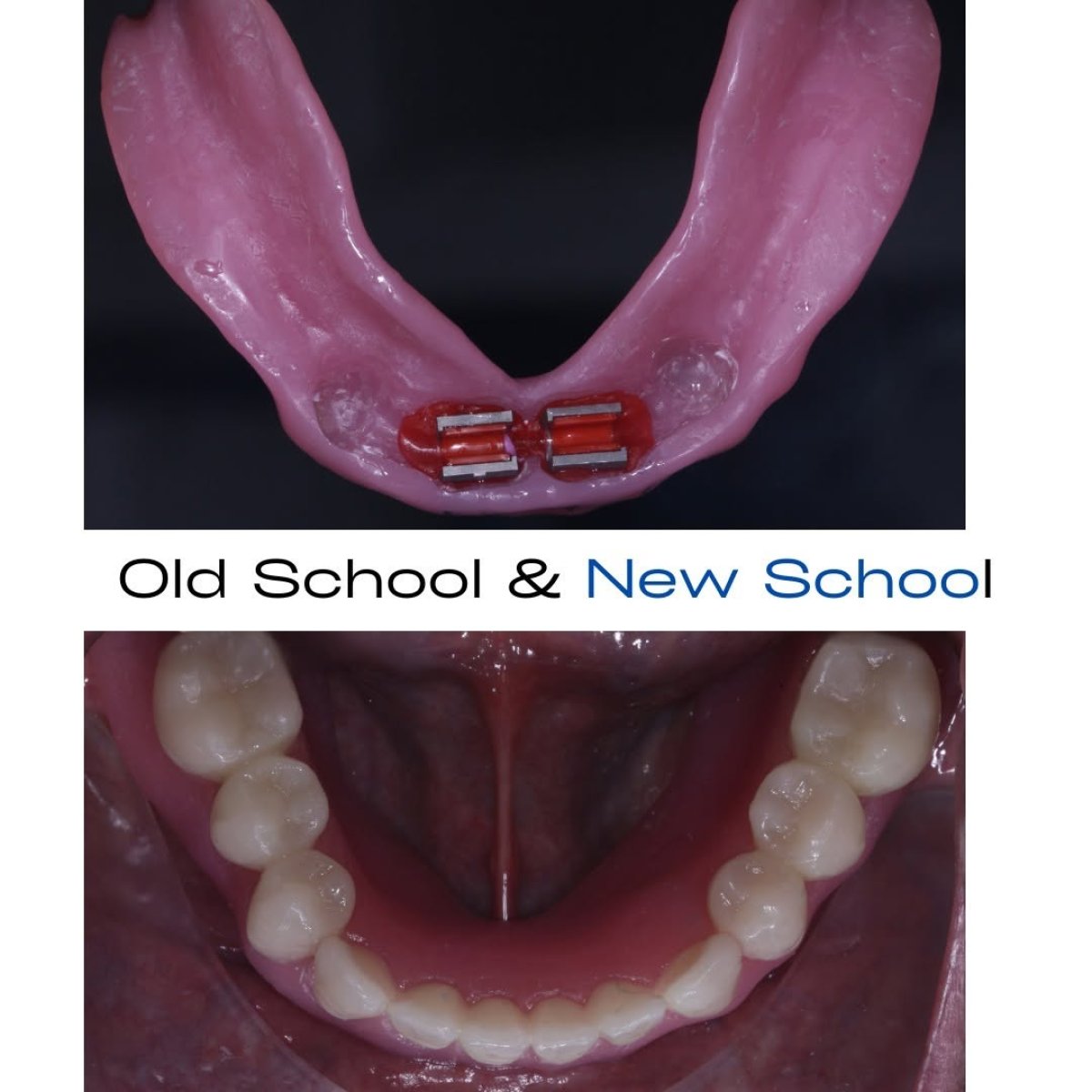 Resultados antes y después de implantes All-on-4 – restauración dental mandibular