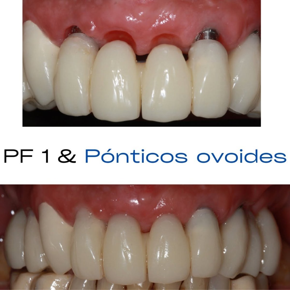 Resultados antes y después de implante dental con corona, restauración de dientes frontales