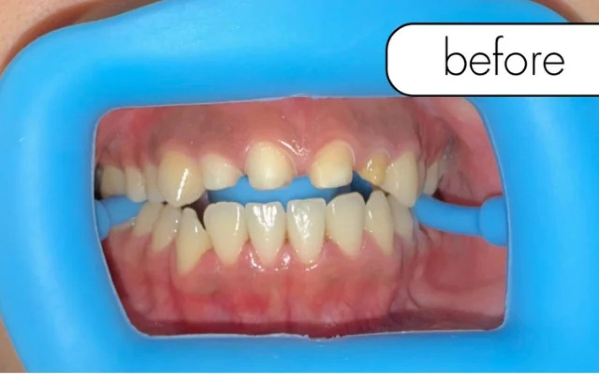Antes de la instalación de coronas dentales en la clínica: daño y desalineación dental