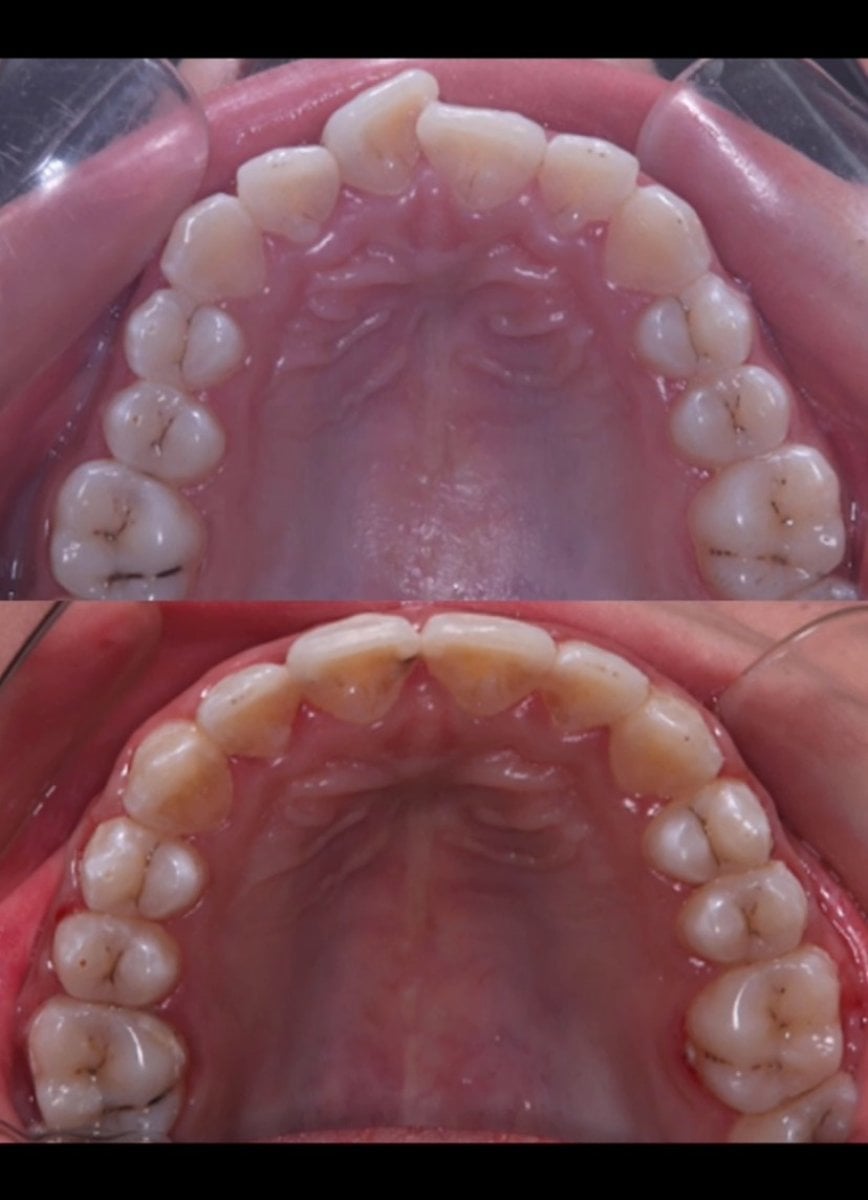 Resultados antes y después de brackets: mejora en la alineación dental superior tras ortodoncia