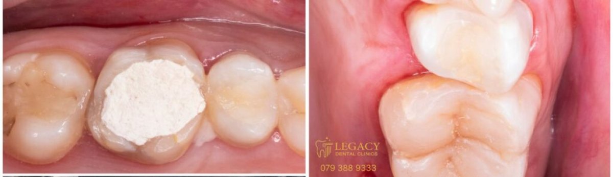نتيجة حشو تجميلي قبل وبعد في Legacy Dental Clinics – استعادة مظهر السن الطبيعي