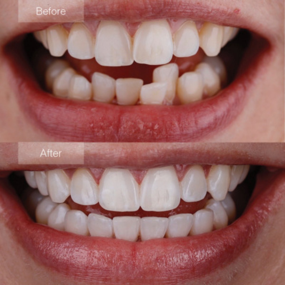 Resultados antes y después de Invisalign – alineación dental y mejora de sonrisa en clínica