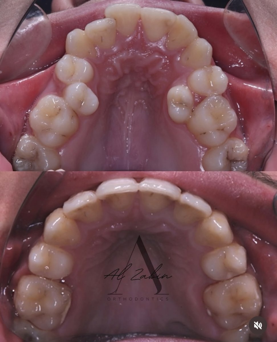 نتائج قبل وبعد تقويم Invisalign في Al Zakin Orthodontics – تحسين انتظام الأسنان