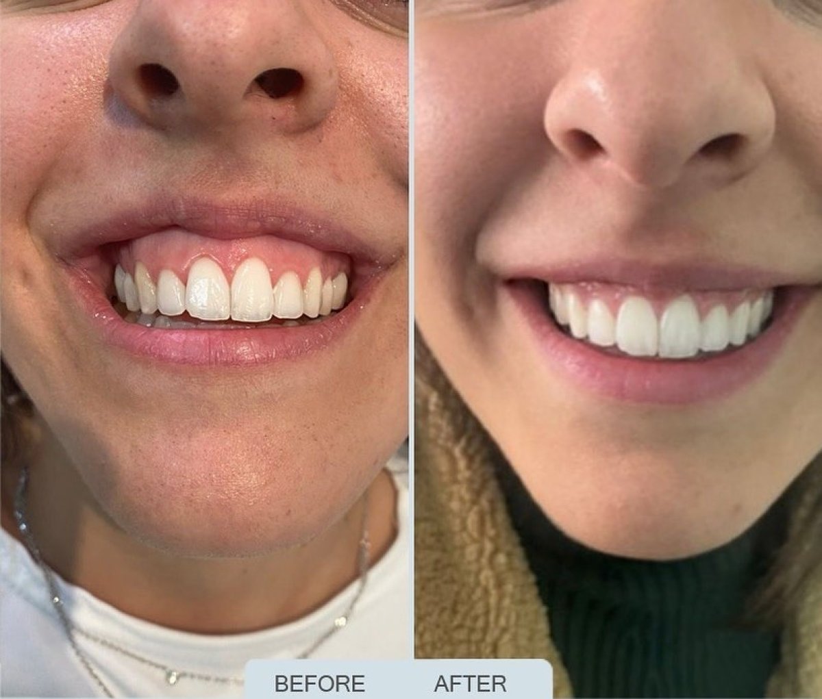 Resultados antes y después de corrección de sonrisa gingival con carillas dentales