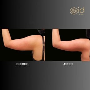 Résultats avant/après liposuccion des bras à ID Clinic Bangkok, amélioration visible du contour
