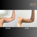 Résultats avant/après liposuccion des bras à ID Clinic Bangkok, contour du bras amélioré