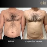 Résultats avant et après liposuccion à ID Clinic Bangkok, amélioration visible du ventre