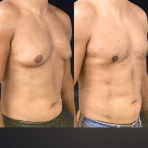 Vorher-nachher-Ergebnis 360°-Liposuktion bei Memorial Bahçelievler Hospital, männliche Kontur