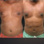 Vorher-nachher-Ergebnis 360°-Liposuktion bei Memorial Bahçelievler Hospital, verbesserte Körperkontur