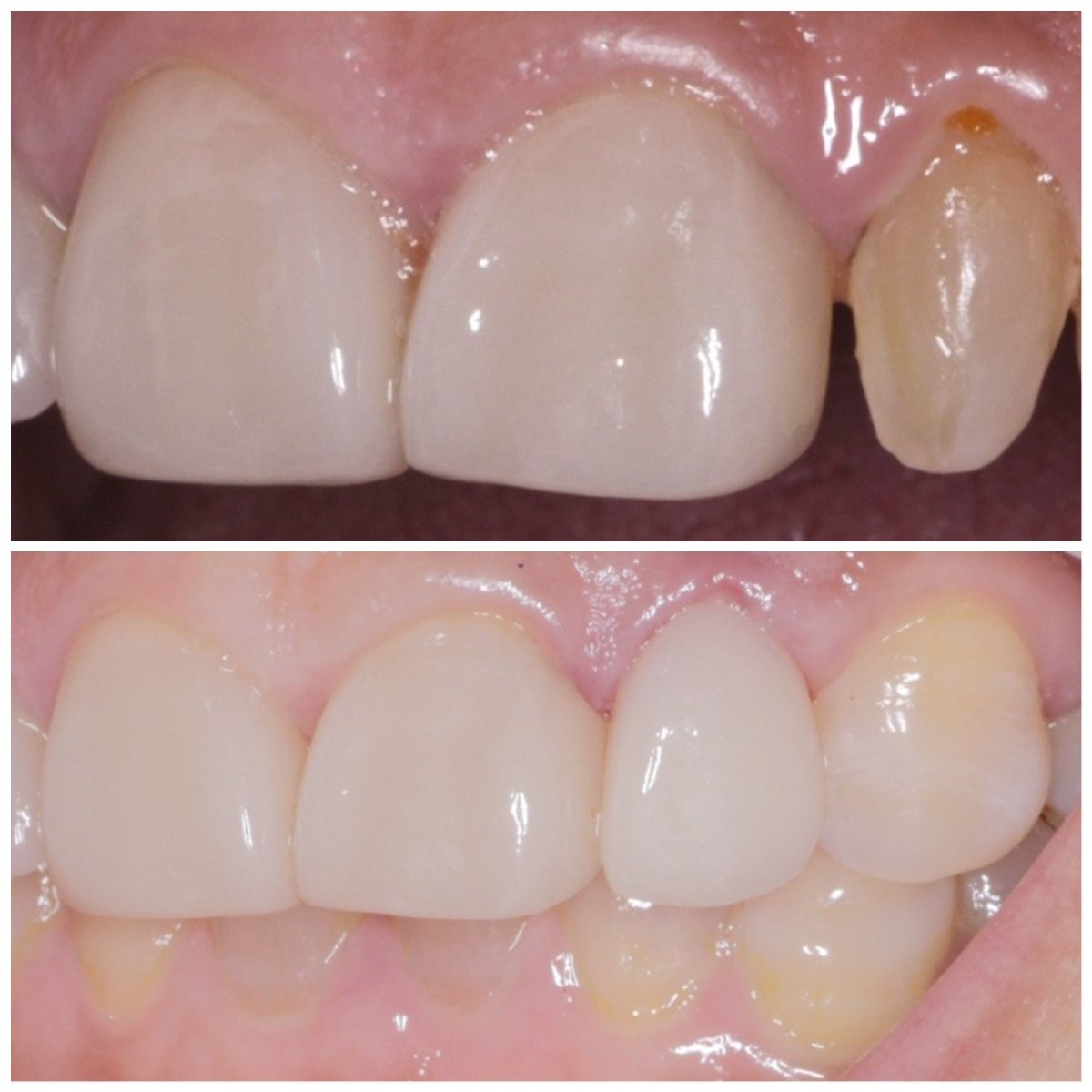 Resultados antes y después de carillas Emax en Wuhan Yiya Simei Dental Hospital, restauración de sonrisa