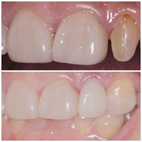 Before and after Emax veneers result at Wuhan Yiya Simei Dental Hospital, smile restoration