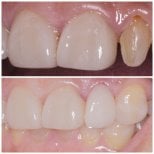 Before and after Emax veneers result at Wuhan Yiya Simei Dental Hospital, smile restoration