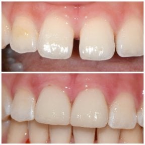Before and after Emax veneers result at Wuhan Yiya Simei Dental Hospital, smile makeover