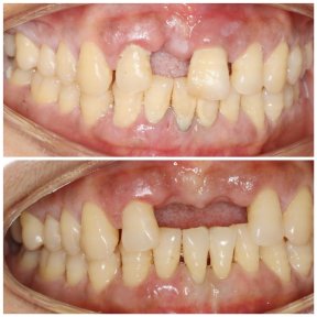نتائج قبل وبعد جينجيفكتومي في عيادة Shanghai Y+bo Dental، تحسين شكل اللثة