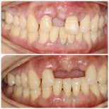 نتائج قبل وبعد جينجيفكتومي في عيادة Shanghai Y+bo Dental، تحسين شكل اللثة