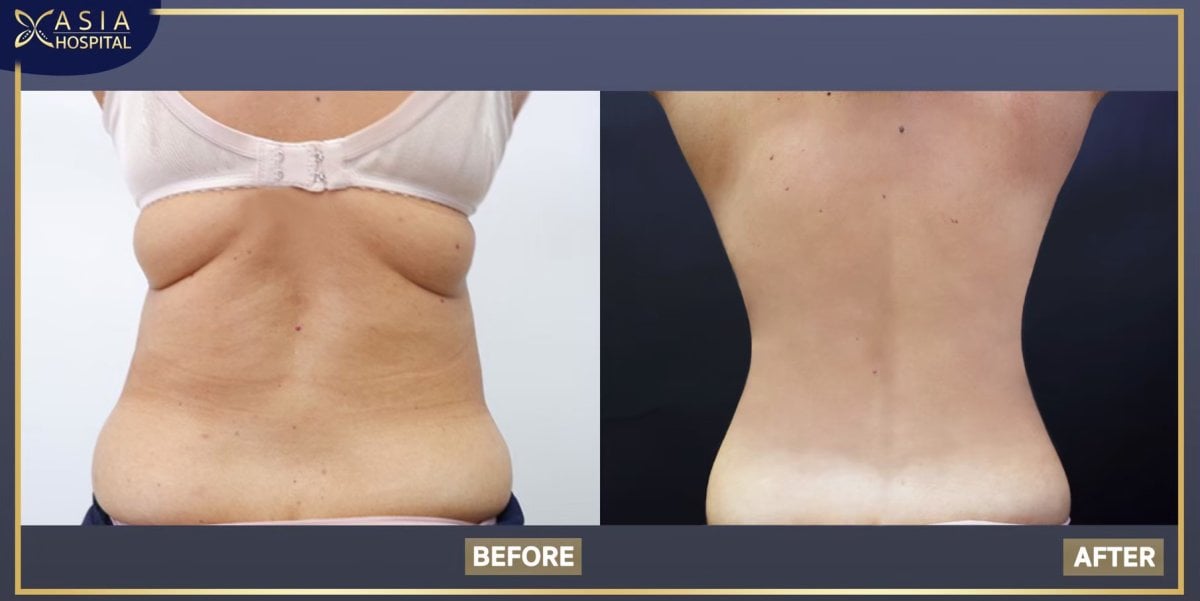 نتائج قبل وبعد شفط الدهون 360 في Asia Cosmetic Hospital، تحسين شكل الجسم