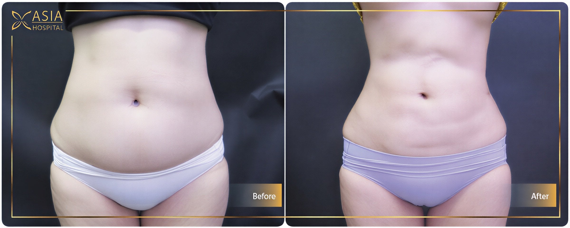 نتائج شفط الدهون 360 قبل وبعد في Asia Cosmetic Hospital مع إبراز محيط الخصر