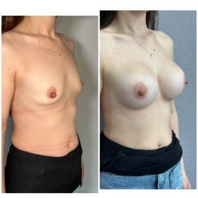 before-after photo uvelicenie-grudi