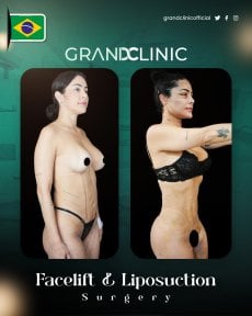before-after photo pectoral-implants
