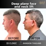 Résultats avant/après lifting visage et cou deep plane à ID Clinic Bangkok