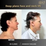 Résultats avant/après lifting visage et cou deep plane à ID Clinic Bangkok, effet lift visible