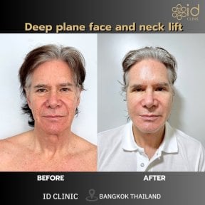 Résultats avant/après lifting deep plane au ID Clinic Bangkok, rajeunissement visible