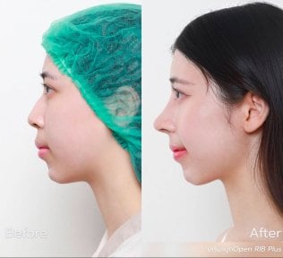 Résultat avant et après rhinoplastie fermée à la DGB Clinic, profil du nez amélioré