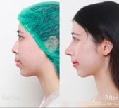 Résultat avant et après rhinoplastie fermée à la DGB Clinic, profil du nez amélioré