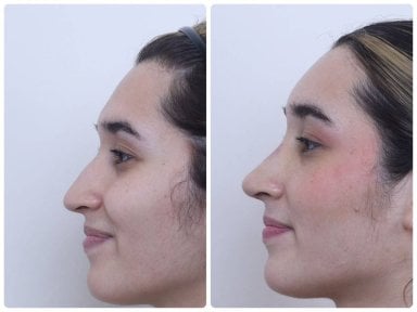 Résultats avant et après rhinoplastie fermée à la DGB Clinic, profil nasal amélioré