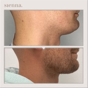 Résultat avant/après greffe de barbe à la Sienna Clinic, restauration visible de la barbe