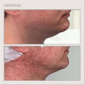 Avant et après retrait du double menton à la Sienna Clinic, amélioration du contour de la mâchoire