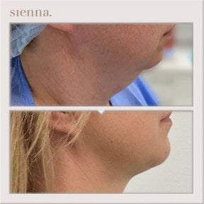 Avant/après liposuccion du double menton à Sienna Clinic – contour de la mâchoire visible