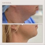 Avant/après liposuccion du double menton à Sienna Clinic – contour de la mâchoire visible