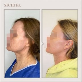 Résultats lifting visage avant/après à Sienna Clinic, amélioration du contour de la mâchoire