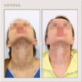Résultats lifting du cou avant/après à Sienna Clinic, peau raffermie et contour amélioré